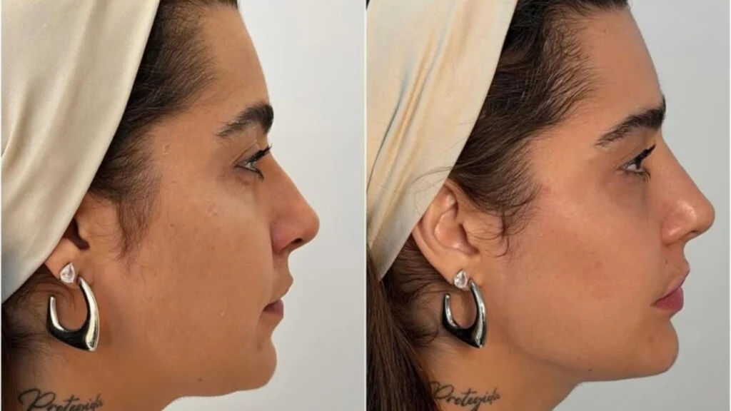 Harmonização Facial Natural Agora é Possível com Resultados Discretos Harmonização Facial Natural Agora é Possível com Resultados Discretos