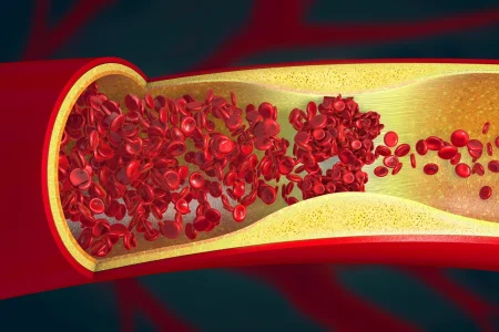 Cardiologista aponta os 2 piores hábitos que “entopem” as artérias