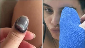 Atriz Carol Macedo passa por cirurgia após prender dedo na porta do carro hoje