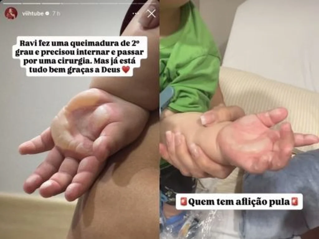 Filho de Viih Tube sofre queimadura e faz cirurgia de emergência após acidente hoje