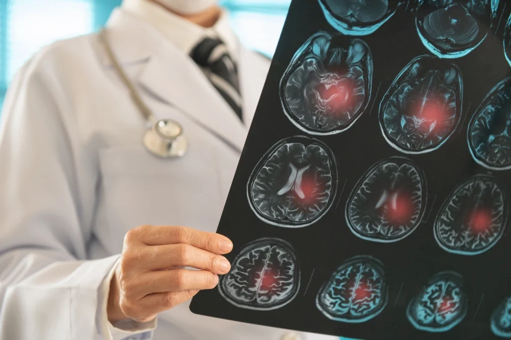 Neurologista alerta para sintomas leves que podem surgir antes do AVC